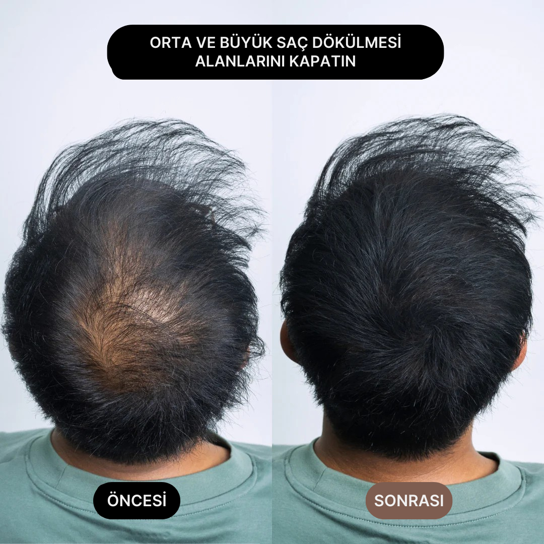 Su geçirmez saç kapatıcı ile orta ve büyük saç dökülmesi alanlarının önce ve sonrası.