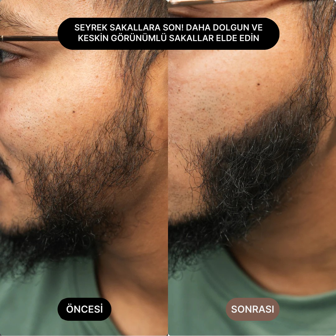 Öncesi ve sonrası görüntüsü ile seyrek sakallara son; daha dolgun ve keskin görünüm.