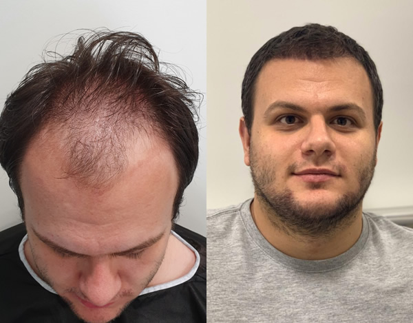 Hair Transplant Before & After Results - Thor Hair Transplant in Turkey