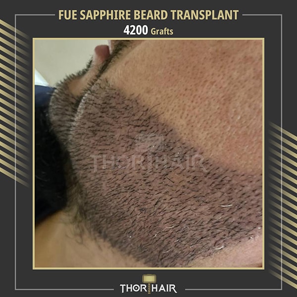 beard transplant in turkey