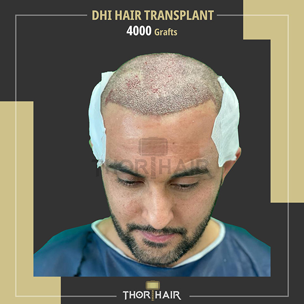 DHI Hair Transplant in Turkey - Thor Hair Transplant in Turkey