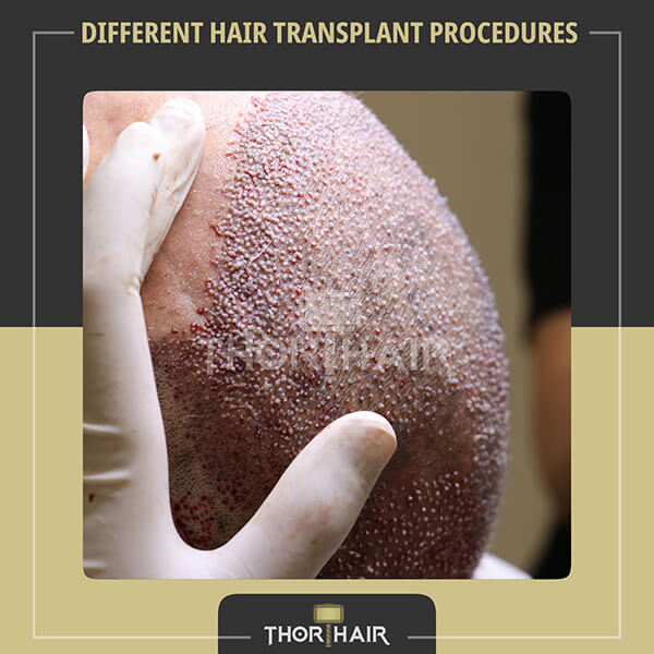 Different Hair Transplant Procedures